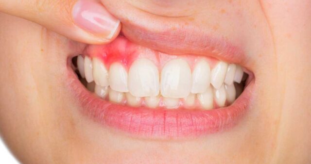 Diş Eti Hastalıkları ve Tedavisi