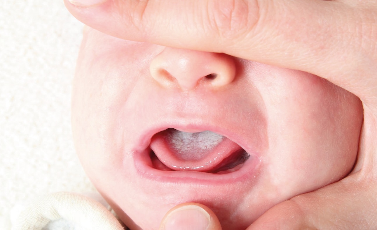 bebeklerde mantar belirtileri ve tedavisi