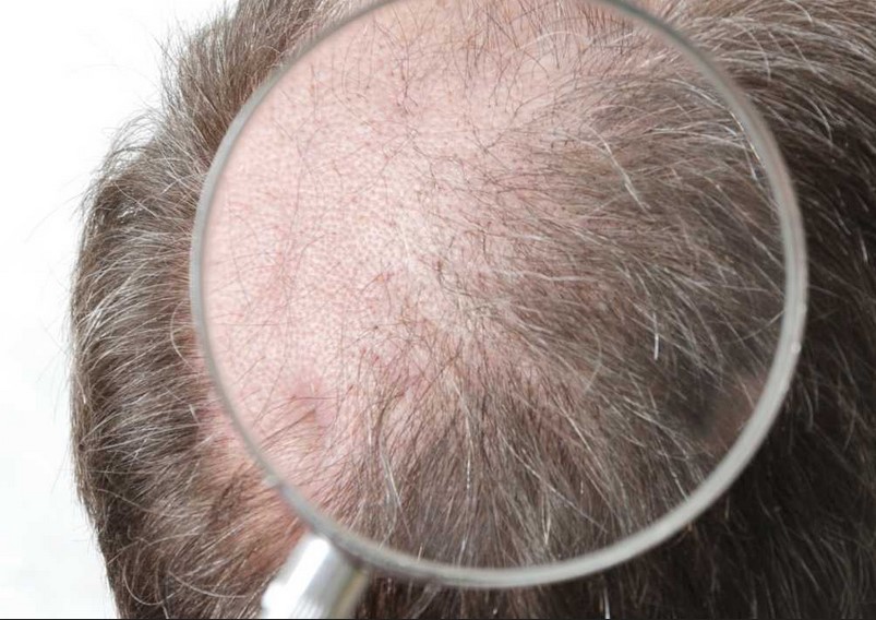 8000 grafts worked to transplant hair