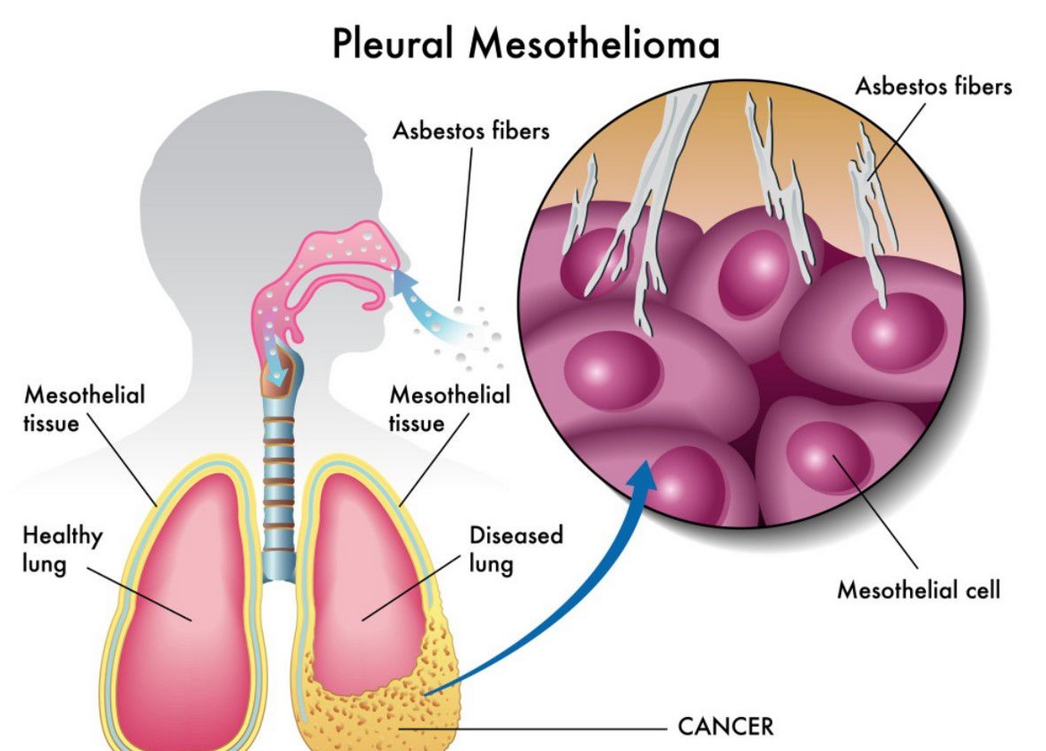 what is the difference between asbestosis and mesothelioma