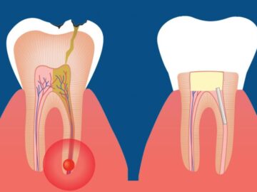 Root Canal Treatment: What to Expect and How Long Does It Take?
